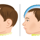 Niño normal y niño microcéfalo. Imagen: Luciano Cosmo / Shutterstock
